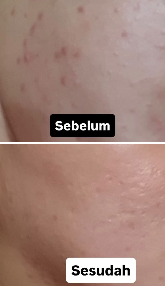 Foto pipi pelanggan sebelum dan sesudah minum Novia: jerawat berkurang